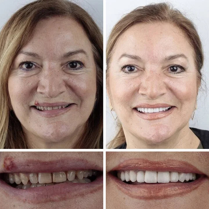 🔥Ends Today: 70% OFF!(Affordable Beauty🧏♀️🧏♂️)--KLENIMORE™ --Advanced Customized Full Denture Set🦷