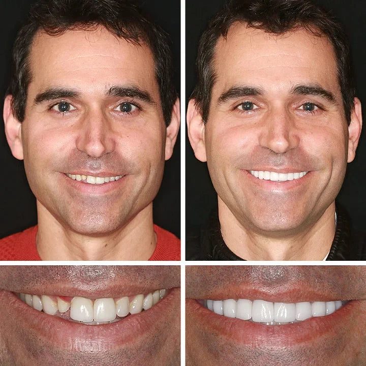 --Ends Today: 75% OFF! ⏰DarkFairy™ Medical Full Denture with Strong Suctiond Custom-Fit Full Functional Dentures🦷